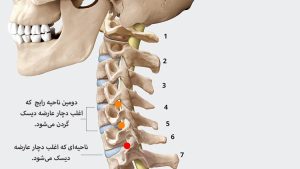 دیسک گردن با دکتری در تهران حسن محمدی