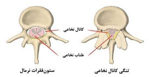 تنگی کانال نخاعی کمر