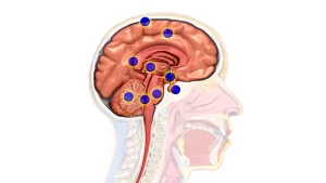 تفاوت بین تومور مغزی اولیه و تومور مغزی متاستاتیک