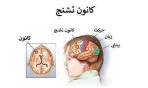 تشنج چیست