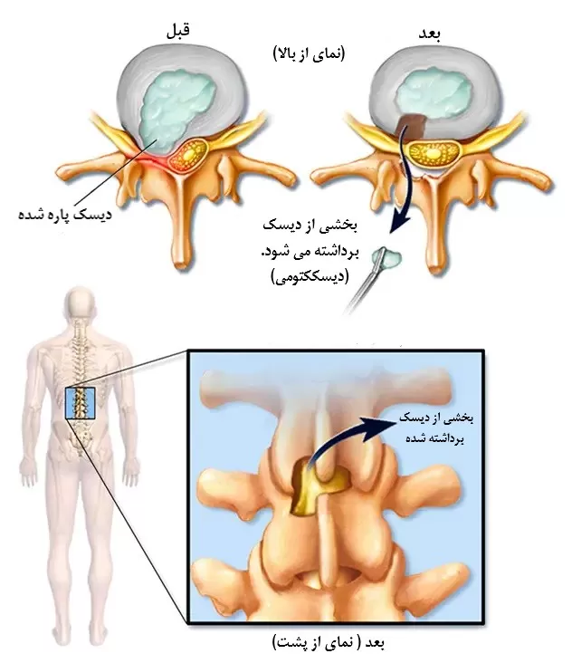 عمل دیسککتومی عمل دیسککتومی