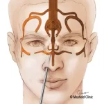 جراحی تومور هیپوفیز از طریق بینی (رویکرد ترانسفنوئید): روش انجام و مزایا