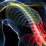 درمان قطعی سیاتیک: روشهای جراحی و غیرجراحی