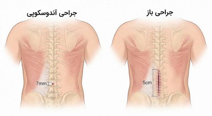 آندوسکوپی ستون فقرات