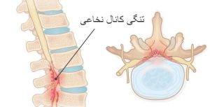 تنگی کانال نخاعی کمر