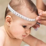 بدشکلی جمجمه نوزاد (کرانیوسینوستوز)