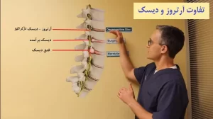 آرتروز ستون فقرات