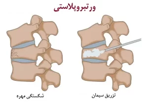 ورتبروپلاستی
