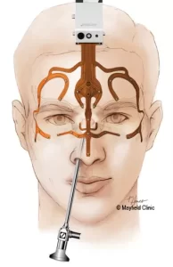 جراحی تومور هیپوفیز