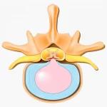 عود دیسک کمر: علت، علائم، درمان و پیشگیری